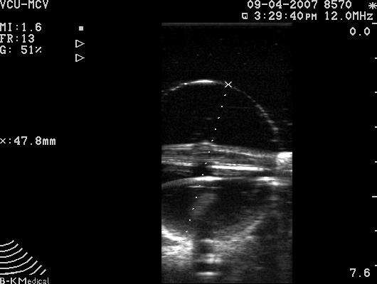 Ultrasound Image of Contura Central lumen