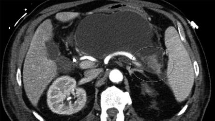 Surgical Drainage Lateral pancreaticojejunostomy Chronic pancreatitis with dilated duct