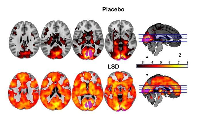 Effects of LSD on Brain Activity Researchers studied how brain activity is