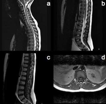 Figure 1: MRI of the spine shows high T2 signal within the spinal cord (a), spinal