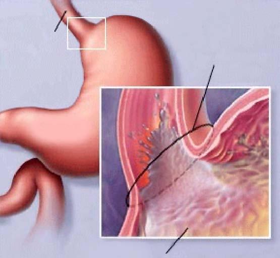 Gastro-Oesophageal Reflux Disease This sheet gives you information about Gastro-Oesophageal Reflux Disease & Fundoplication Surgery What is gastro-oesophageal reflux disease?