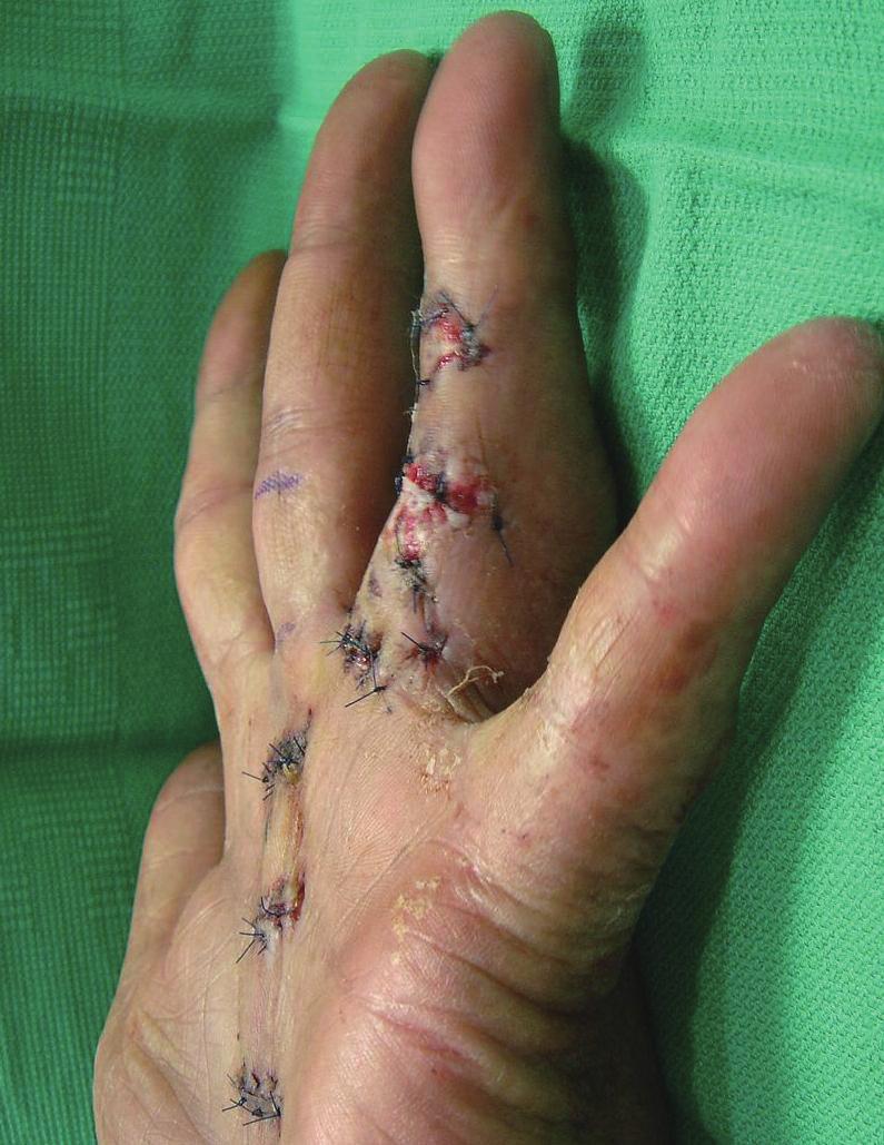 have proved to be largely ineffective and rejected clinically [3]. Surgery continues to be the gold-standard treatment for progressive Dupuytren s contracture.