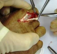 A small portion of the extensor expansion taken with the