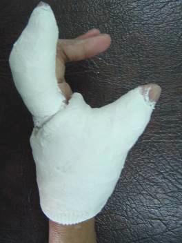 splinting and serial casting aid static splinting Adequate thumb web: A