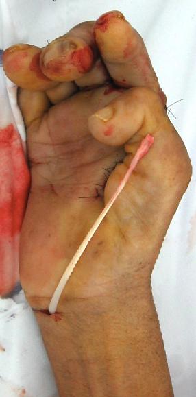 The best plane for the transfer is superficial to the palmar fascia in the subcutaneous layer.