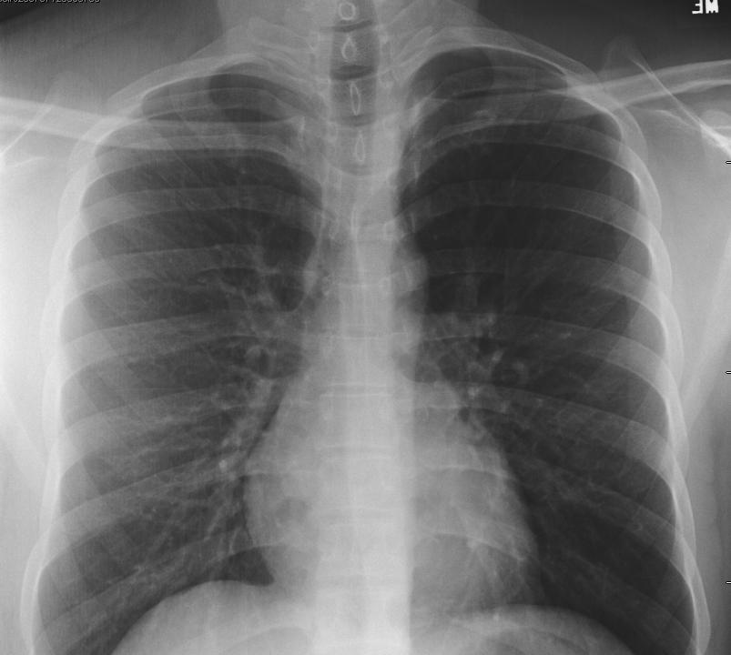 Apical Lordotic view provides further confirmation Repeat CXR 5 days later after requesting re-do with