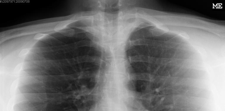 TB?...Review film yourself (or with trusted clinician) Don t rush to Chest CT in uncertain TB cases Recall