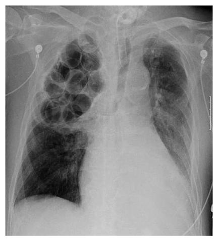 What s This? This 75 yo man comes in to ER w/ dyspnea. From the CXR what is the diagnosis? 1. Aspergillosis 2. Active TB 3. Plombage 4. Squamous cell carcinoma 5.