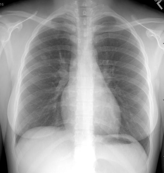 Initial Chest X-Ray Neg. sputum smear x3 Other Diagnoses?