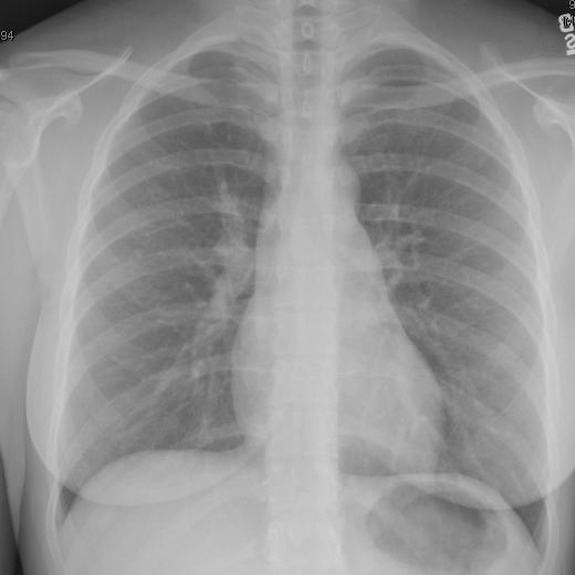 Six Months Post Rx Smear/Culture Negative Pulmonary TB Do not exclude TB diagnosis in highly suspect case 15-20% active TB cases in US culture negative Factors contributing to culture negative: Low #