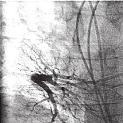 Case Reports in Cardiology 3 (a) (b) Figure 3: (a) Normal right pulmonary angiogram.