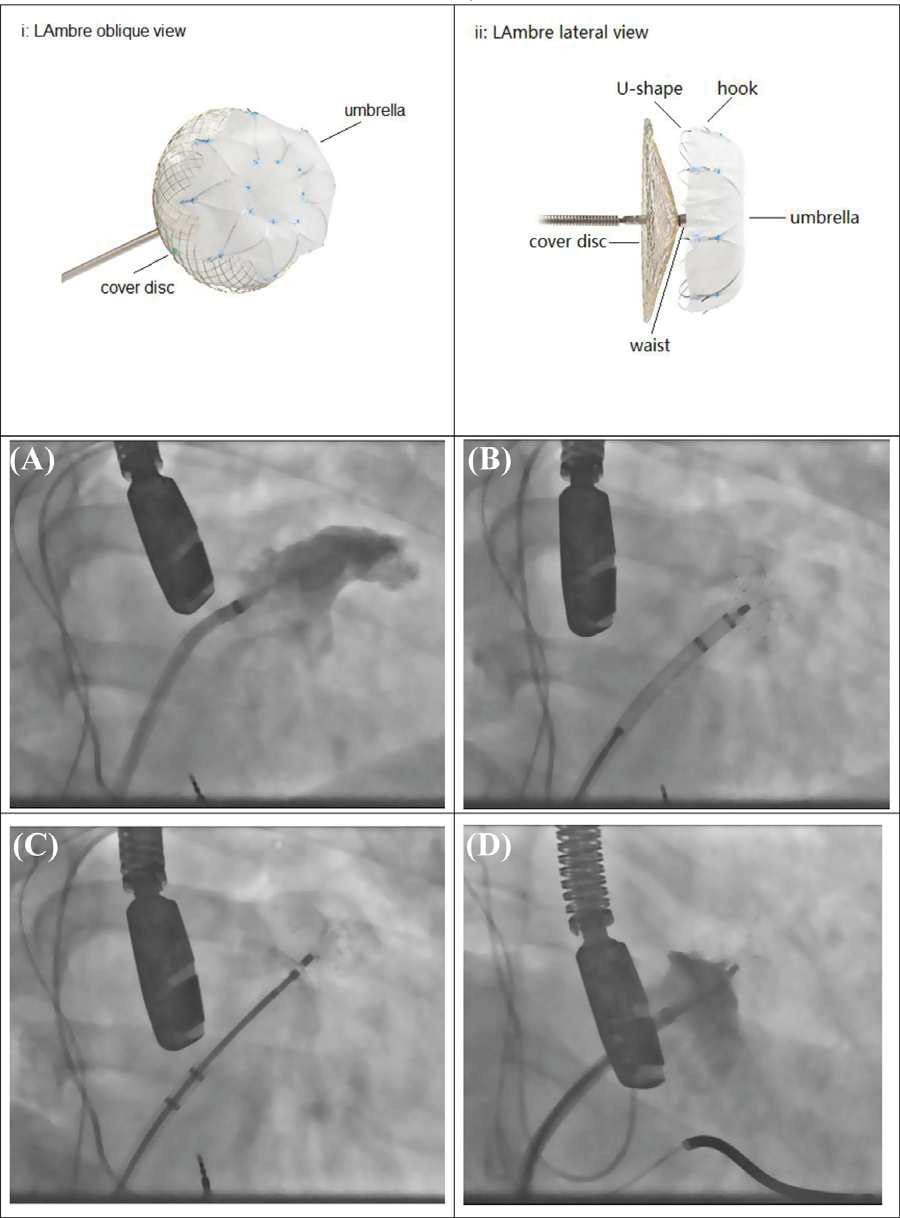 2 CHEN ET AL. FIGURE 1 LAmbre device design and angiography guided implantation [Color figure can be viewed at wileyonlinelibrary.