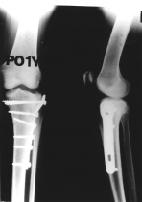 3 3 35 I I 8, 7 mm 2 12 B l o k k e r (Fig 1) Preoperative x-ray shows Schatzker s type II fracture of tibial condyle
