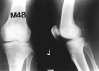 794 Preoperative x-ray shows Schatzker s type II fracture of tibial condyle Open