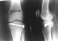 postoperative 1 year shows complete bony healing 48,, I I B l o k k e r B a k a l