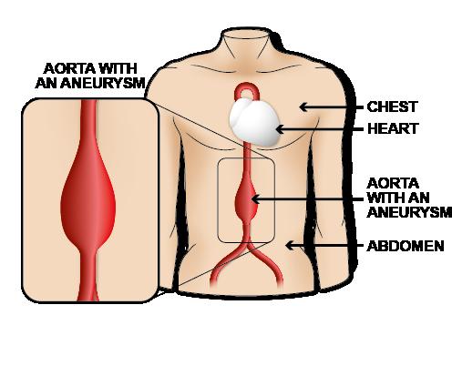 2 What is an abdominal aortic? The aorta is the main blood vessel that supplies blood to your body. It runs from your heart down through your chest and abdomen.