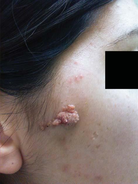 CASE REPORT Serbian Journal of Dermatology and Venereology 2015; 7 (1): 15-22 Further therapy included local use of antibiotic ointments and anti-scar gel (Figure 3).