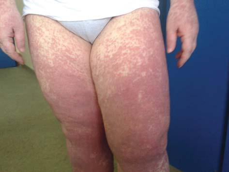 At the first dermatological examination, the patient had diffuse facial flushing with mild edema, and morbiliform skin rash mainly on the extremities.