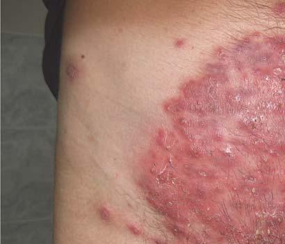 CASE REPORT Serbian Journal of Dermatology and Venereology 2015; 7 (1): 34-40 pathologically, this condition should be distinguished from common tinea profunda, an acute suppurative condition which