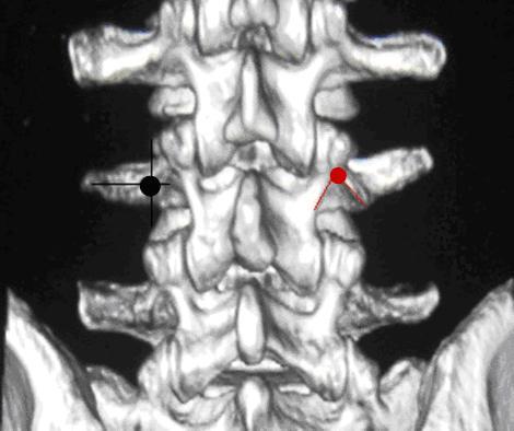 Figures and Tables Figure 1. The entry point of two different methods marked on the posterior vertebral cortex.