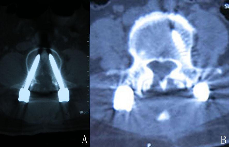 Figure 2. The axial CT scans. A represents Du s method, B represents Magerl s method.