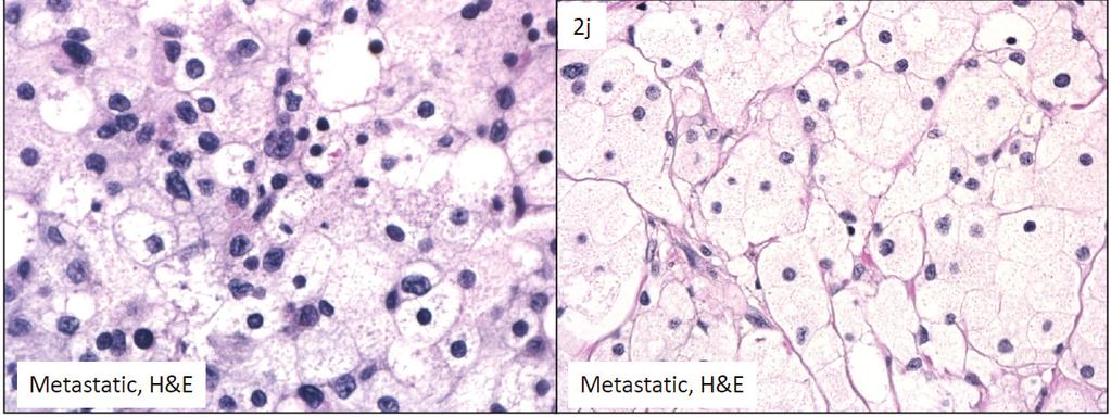 The balloon melanoma cells are arranged in nests separated by thin fibrous septae and are histologically identical to those seen in the primary lesion (H&E, 10x); (i) Metastatic BCMM.