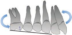 Reciprocal forces from moments of couples applied to increase anterior lingual root torque (including use of torque ridges 13,64 ) may result in undesirable mesial rotation (tipping) of first molar.