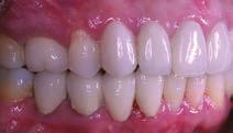 Creative Adjuncts for Clear Aligners G Fig. 24 (cont.) G. Patient after completion of cosmetic restorations. indirect support and control for more predictable programmed tooth movements.