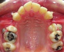 between upper second premolars and first molars.