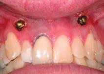 in aligners (see