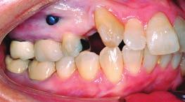 Upper right first premolar