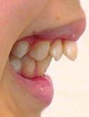 anterior teeth and extended