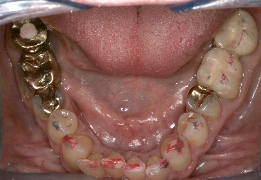 dentistry I Choose: CR if: -There are signs of bite disease -Condyle Disc Assembly is Stable -Vertical