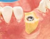 The dental implant is inserted only after bone reconstruction is completed 9 2a Use of Geistlich Bio-Oss Filling of the bone defect with Geistlich Bio-Oss to form new bone 2b Use of Geistlich