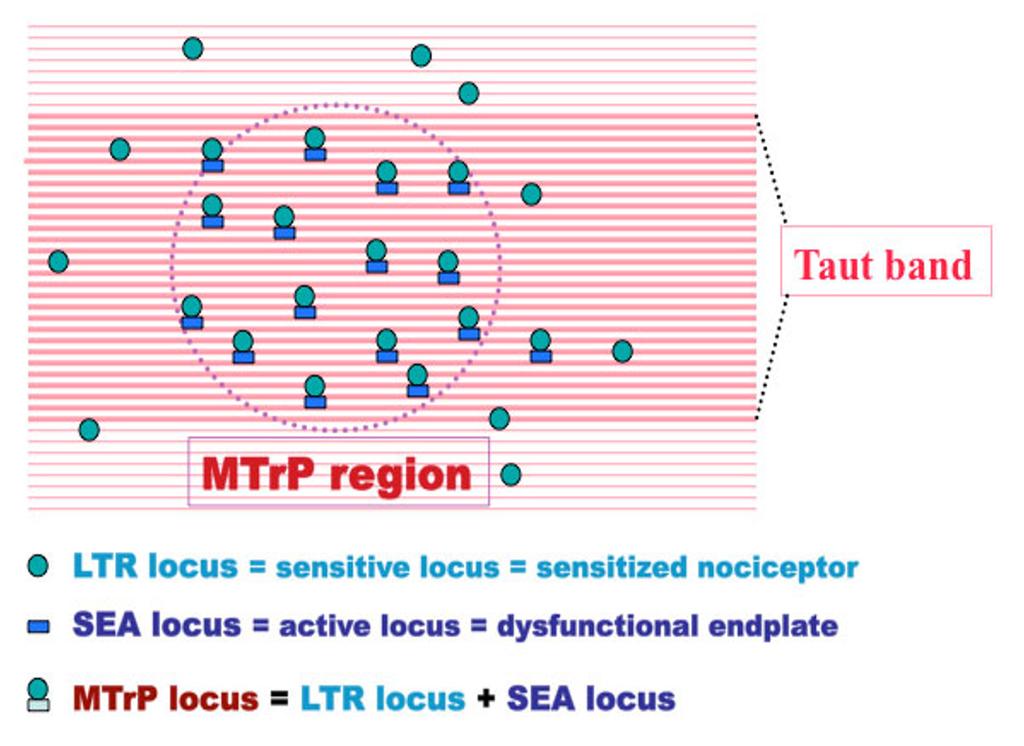 Fig. 1 -Multiple MTrP loci in a myofascial trigger point region. Fig. 2 - Connection of myofascail trigger point circuit ( MTrP circuit ) in the spinal cord.