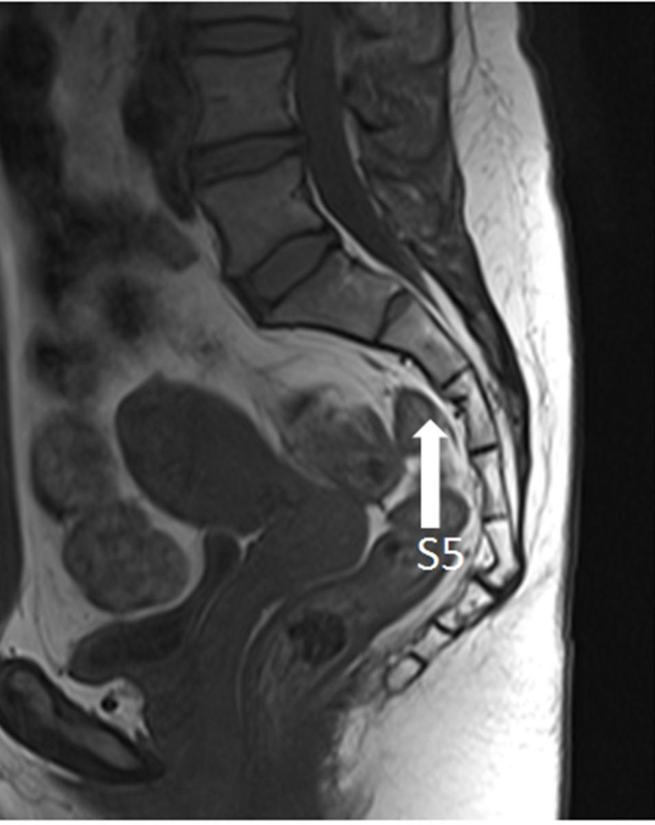 Fig. 4: MRI of sacrococcygeal region which allows counting the vertebrae from S5 upwards.