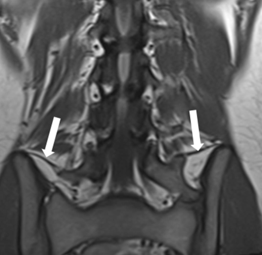 Fig. 6: Coronal T-WI shows an LSTV (Castellvi IIa) and the iliolumbar ligaments.