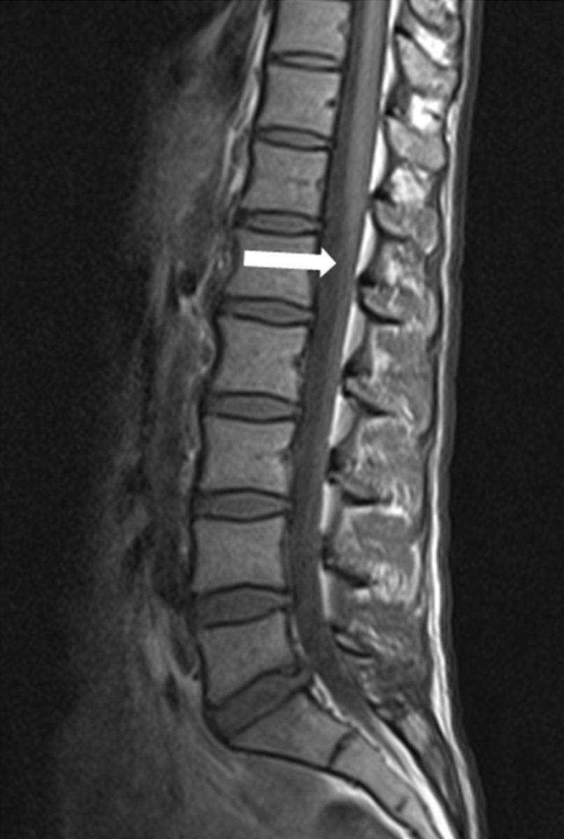 Fig. 9: The sagittal T-WI shows conus medullaris at the level of L vertebral body.
