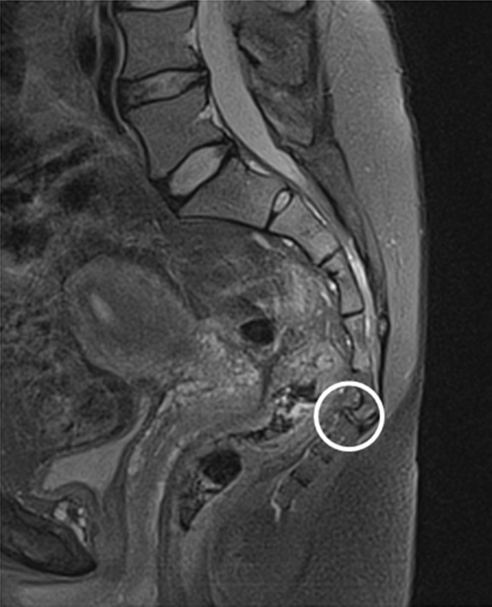 Images for this section: Fig. 3: MRI of sacrococcygeal region which allows counting the vertebrae from S5 upwards.