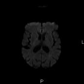 MRI in TIA vs Stroke 2 pa=ents, both with right sided weakness 65 year old man