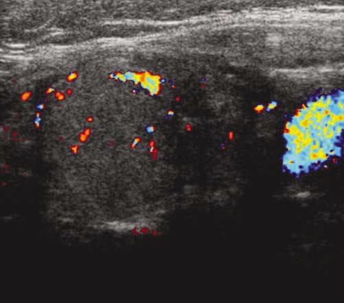 Sagittal image of a solid thyroid nodule shows no visible flow either within or around the periphery of the