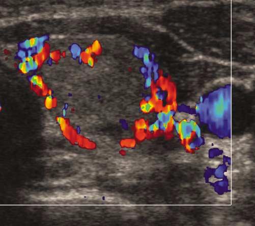 Transverse image of a left solid thyroid nodule shows a small amount of internal flow without a peripheral ring.