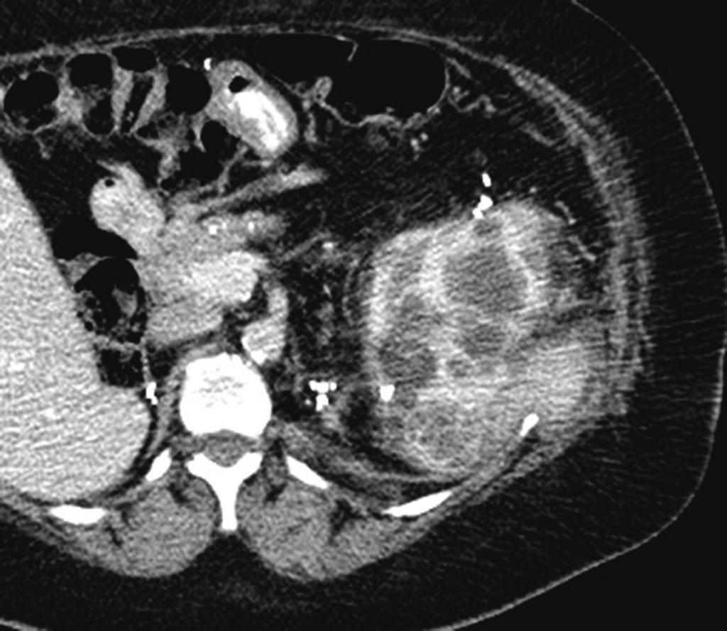 2 Case Reports in Urology Figure 1: Preprocedure enhanced CT shows a mixed solid and cystic enhancing posterior renal tumor (6 o clock in kidney). 2.