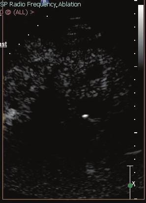 Case Reports in Urology 3 Figure 2: Ultrasound contrast image and grey scale ultrasound before ablation show the perfusion of solid