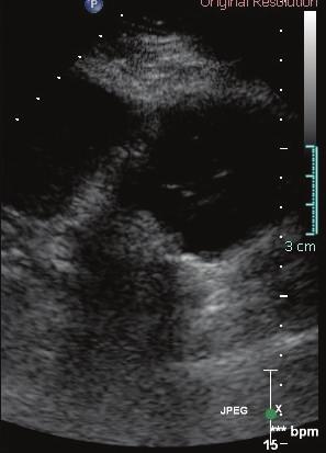 Figure 3: Ultrasound contrast image and grey scale ultrasound show the lack of the perfusion of solid mass with central needle and now