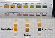 LUTS Assessment: Investigations Urine dipstick test Bloods: Offer a