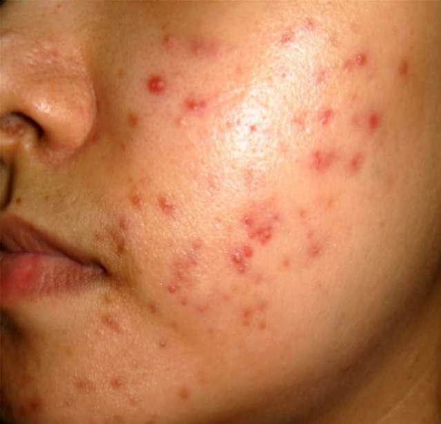 Pharmacotherapy MODERATE ACNE Continue topical benzol peroxide or topical retinoid Use a tetracycline such as (Doxycycline 50-100mg) daily for 4 to 6 months. Can increase to BD if tolerated.