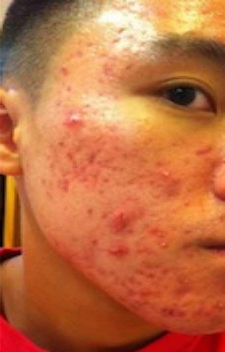 Pharmacotherapy SEVERE ACNE Isotretinoin If unfamiliar with the drug, discuss with a dermatology NP or CNS or dermatologist Retinoid acid (Vit.
