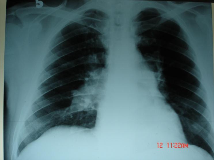 hepatomegaly, jugular stasis are the signs of right heart failure with secondary tricuspidian regurgitation. 10. 2. Clinical and laboratory diagnosis.