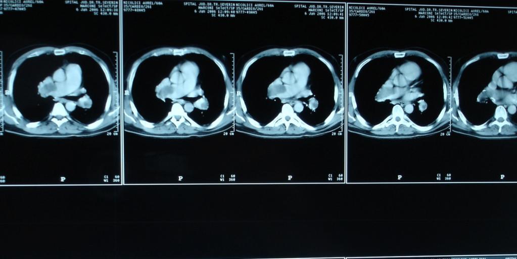 Fig. CT-scan shows thrombi in the right pulmonary artery. Pulmonary angiography and cardiac catheterization - is the clearest method of diagnosis and assessment of the degree of severity (Figure).